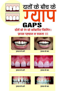 Poster Dental Doctor Gaps In Teeth (Hindi Poster) Large Poster (36 X 24