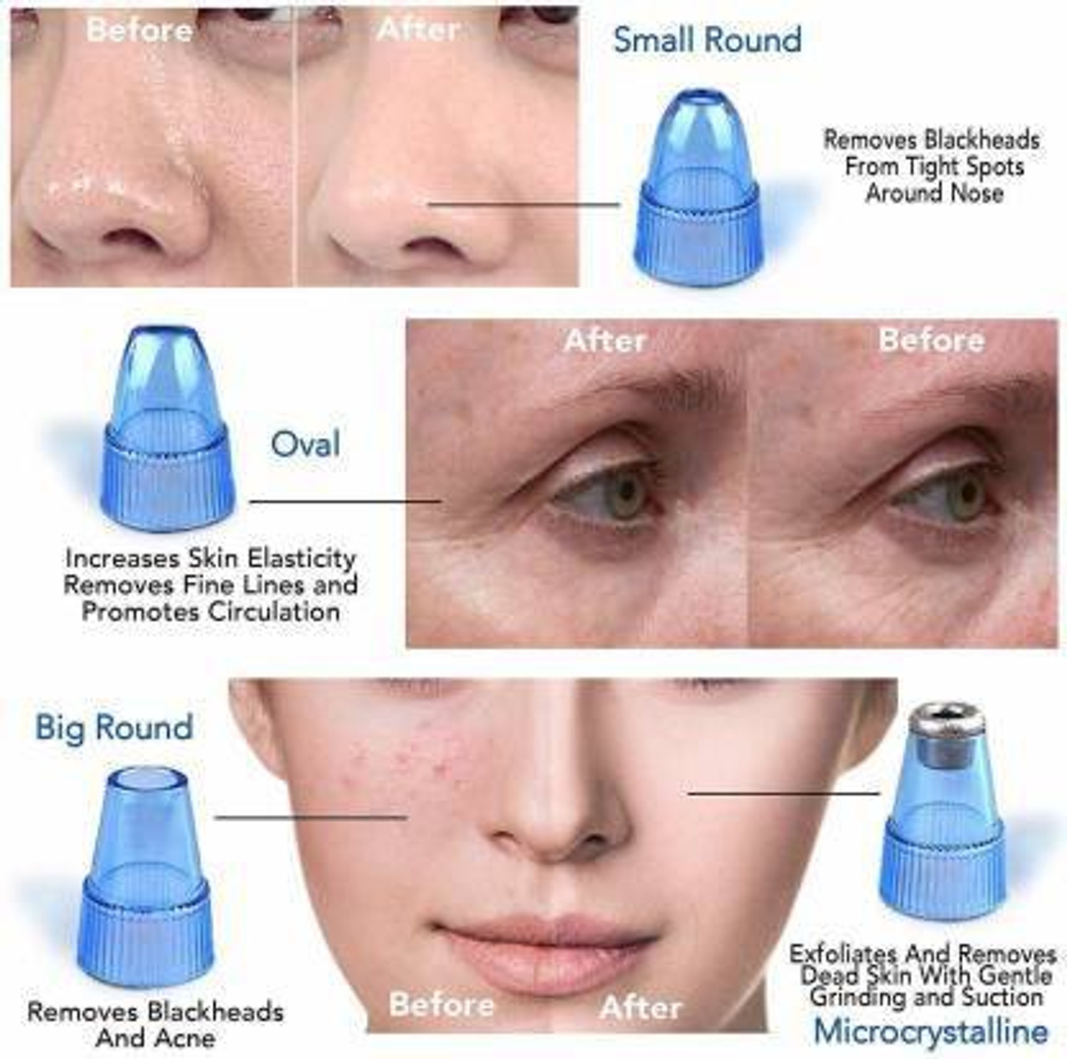 Image of skyunion Carbon Fiber Blackhead Remover Vacuum Suction Device