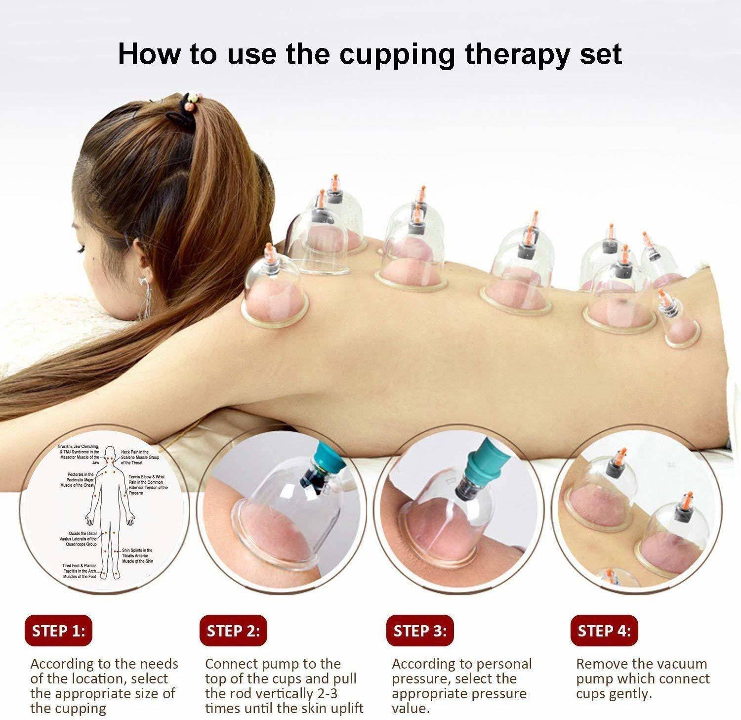 Acs ACUPRESSURE Biomagnetic Chinese Cupping Therapy Vacuum Cupping