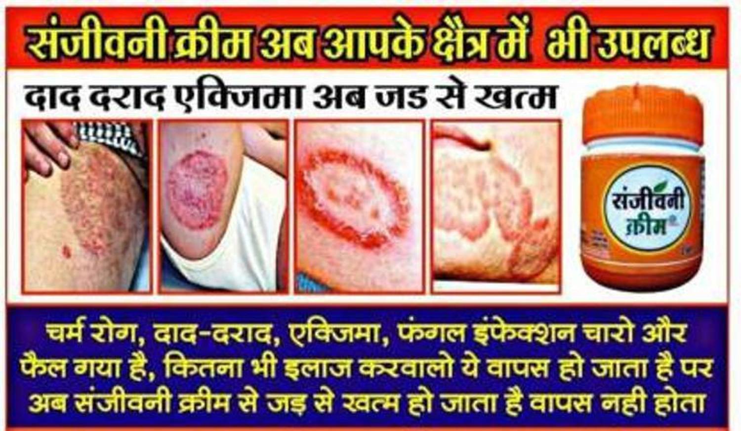 V_GADGETS Fungal Infection cream, Antiseptic Cream (25 g each