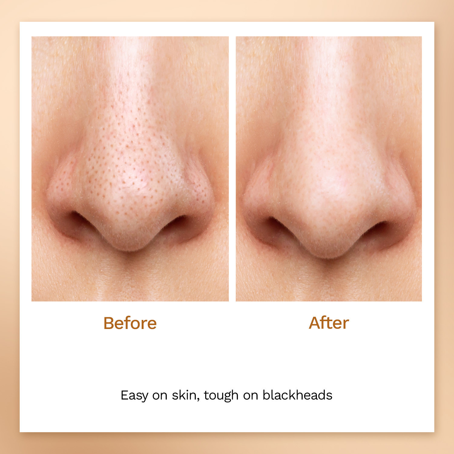 Image of FURR By Pee Safe Fiber Blackhead Remover Strips