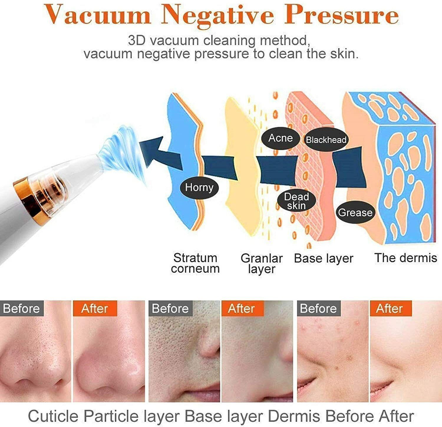 Image of ClothyDeal Plastic, Fiber Blackhead Remover Vacuum Suction Device