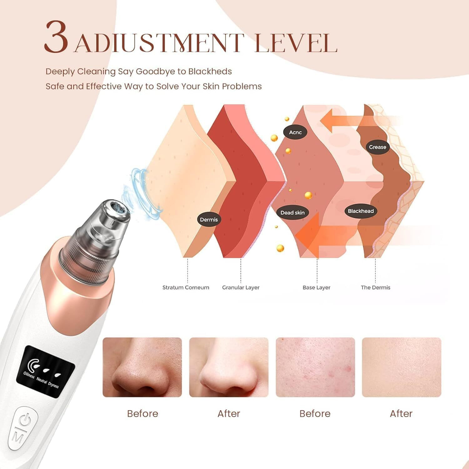Image of FURESTA Plastic Blackhead Remover Vacuum Suction Device