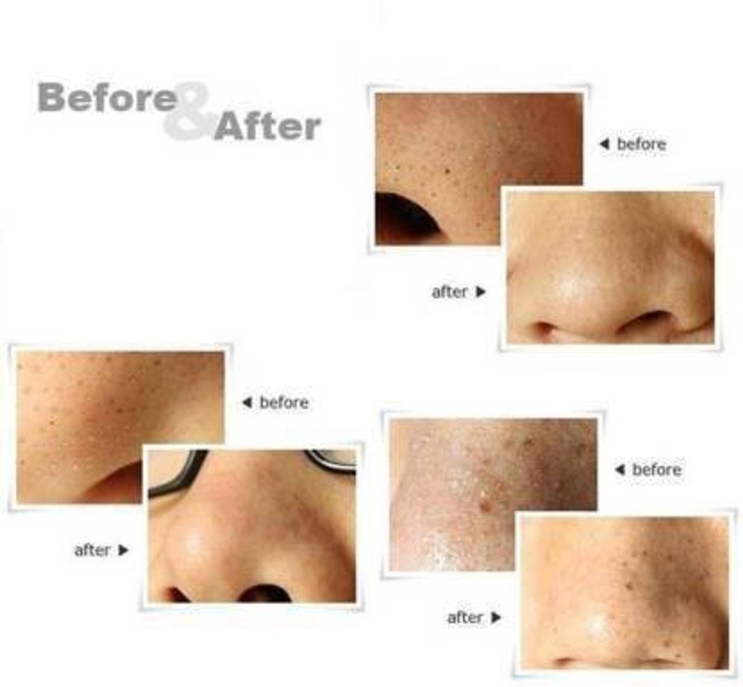 EverGlam Steel Blackhead Remover Needle Pack of 4 - Image 3
