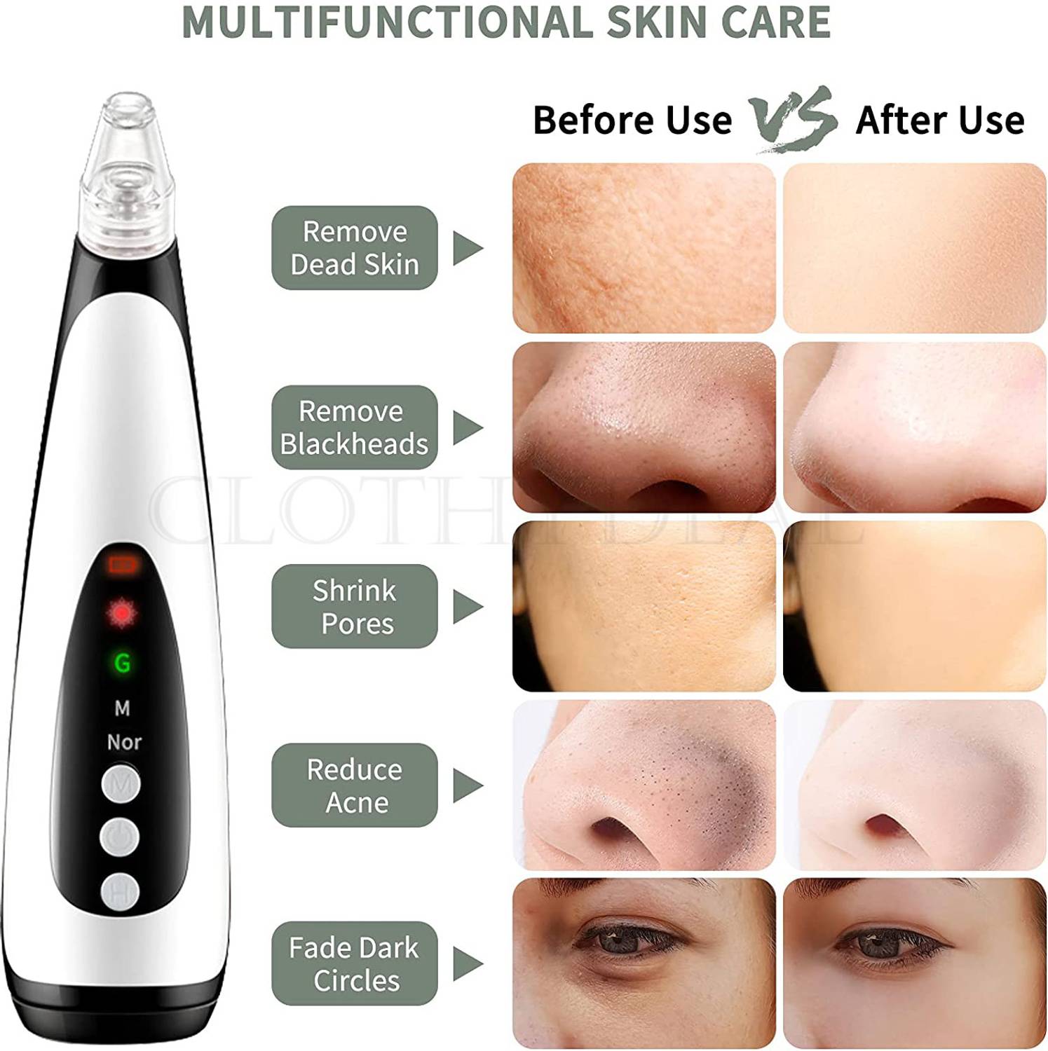 ClothyDeal Blackhead Remover Vacuum Suction Device - Image 2