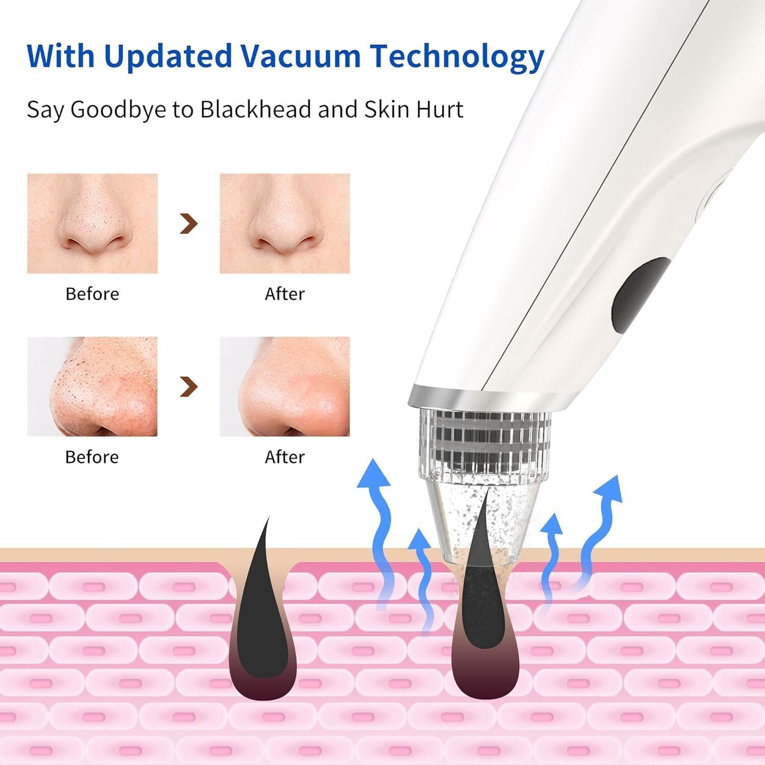 Image of DOCOSS Polymer Blackhead Remover Vacuum Suction Device