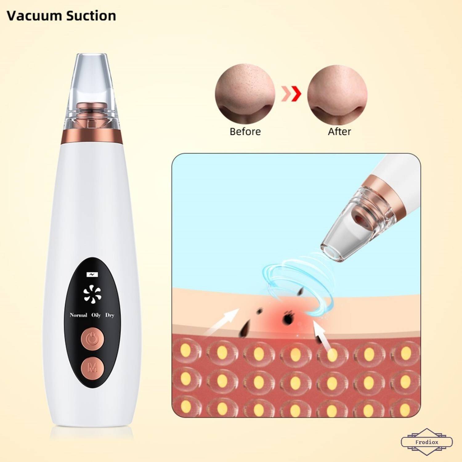 Frodiox Blackhead Remover Vacuum Suction Device - Image 1