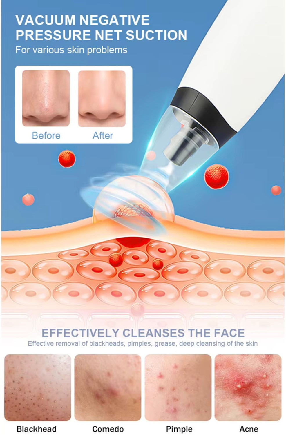 Image of Skylight Plastic Blackhead Remover Vacuum Suction Device