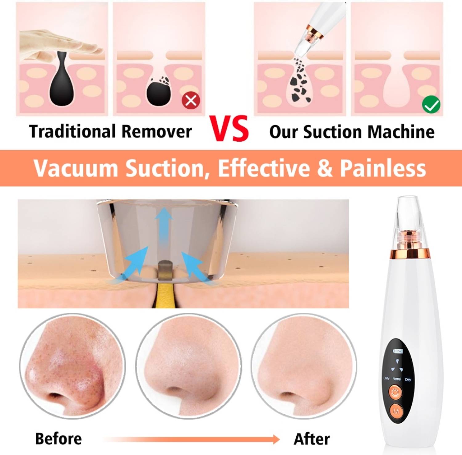 FURESTA Blackhead Remover Vacuum Suction Device - Image 3