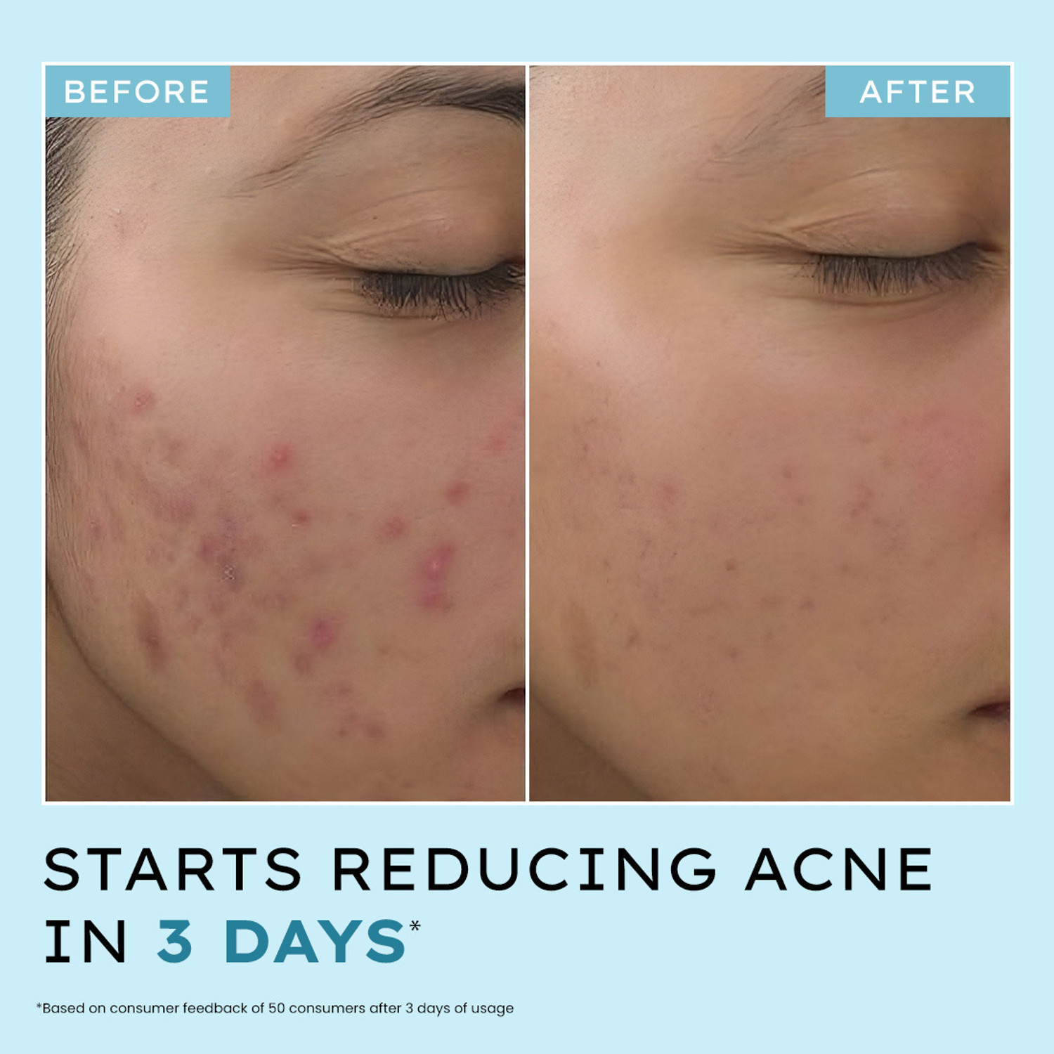 Image of HYPHEN Anti Acne 10% Azelaic Acid 2% Salicylic Acid Face Serum | Fades Acne Marks