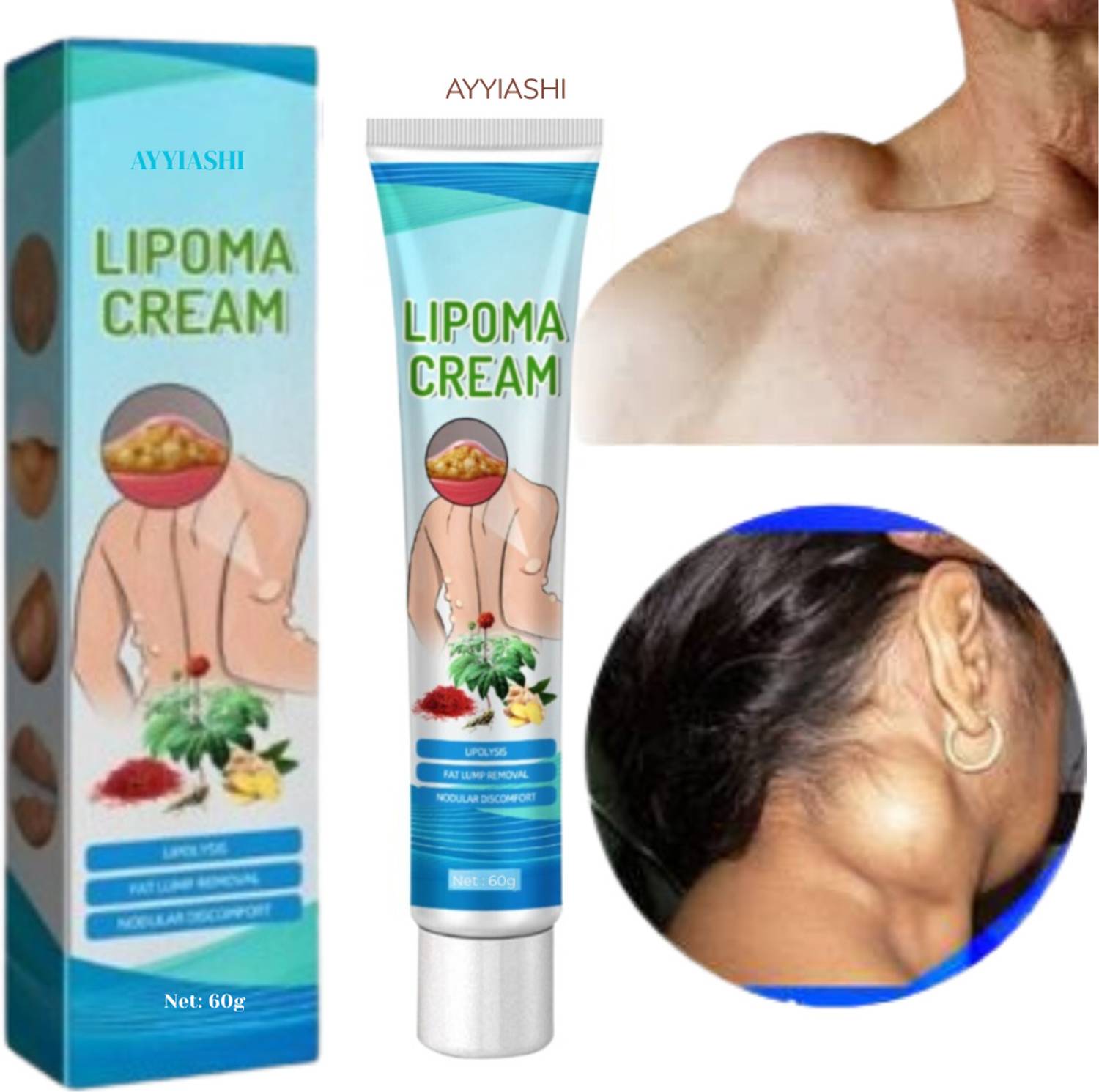 AYYIASHI Lipoma Removal Cream Fat Reducer For Skin Bumps And Nodules
