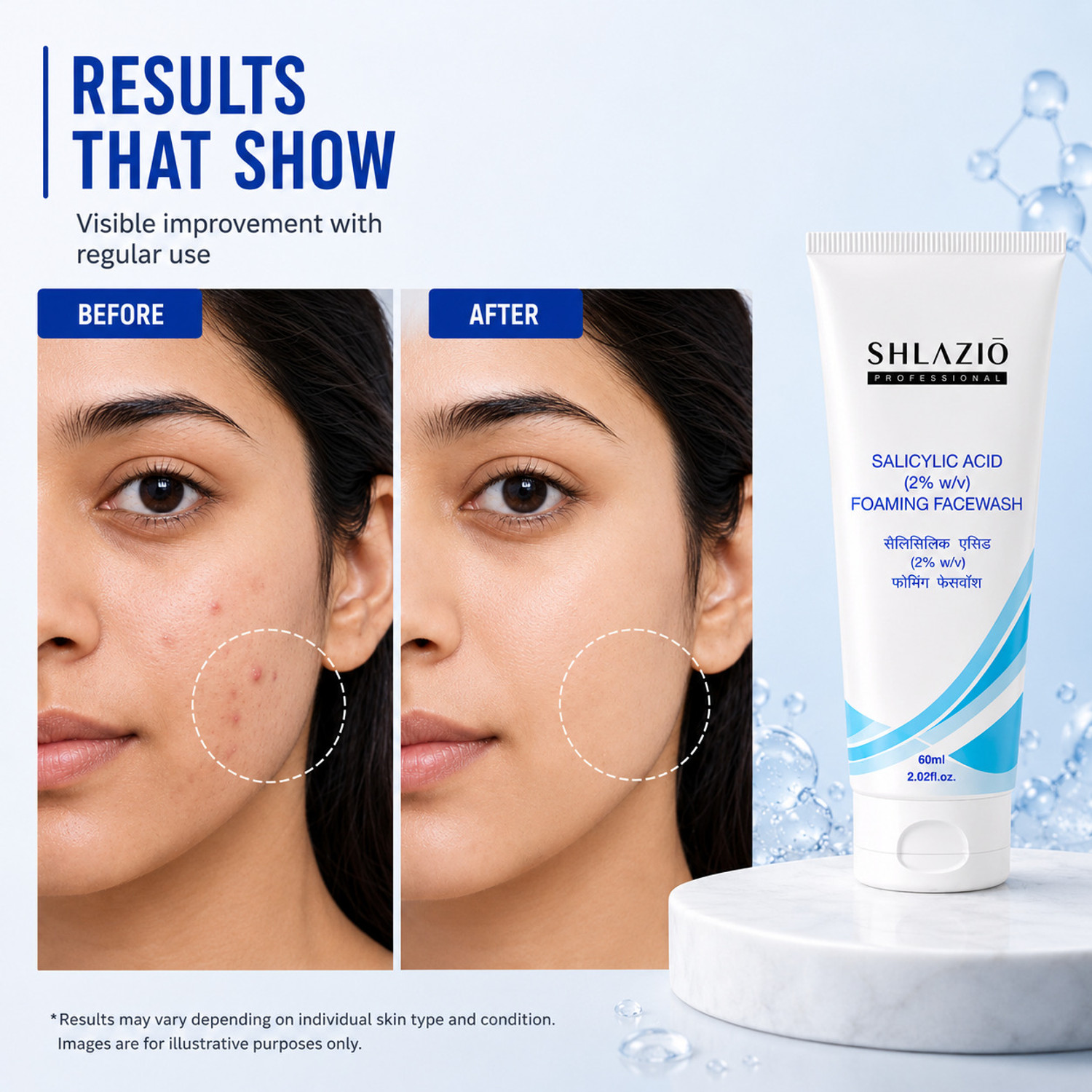 Image of shlazio Salicylic Acid 2% for Acne, Pores, Blemishes & Clear Healthy Skin Face Wash