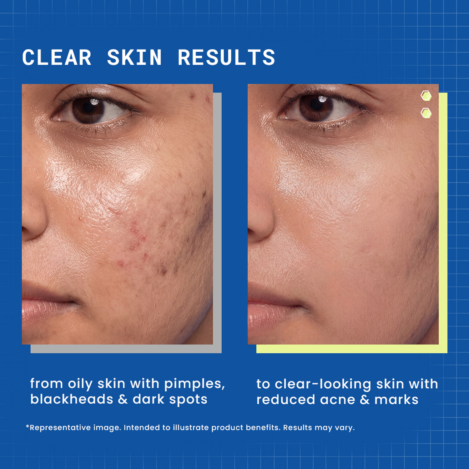 Image of DermDoc 2% Salicylic Acid Cleanser | Clears Pimples, Dark Spots, Whiteheads & Blackheads | Gentle Exfoliation Face Wash