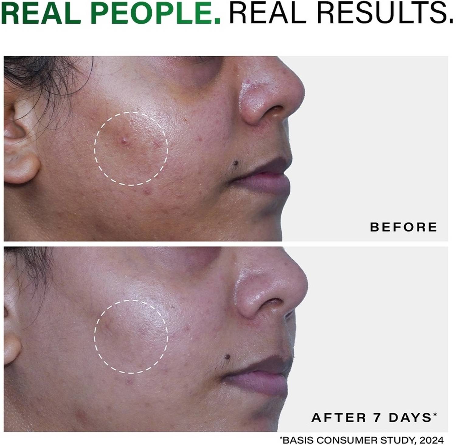 Novology Acne Clearing Face Wash 150g - Image 4