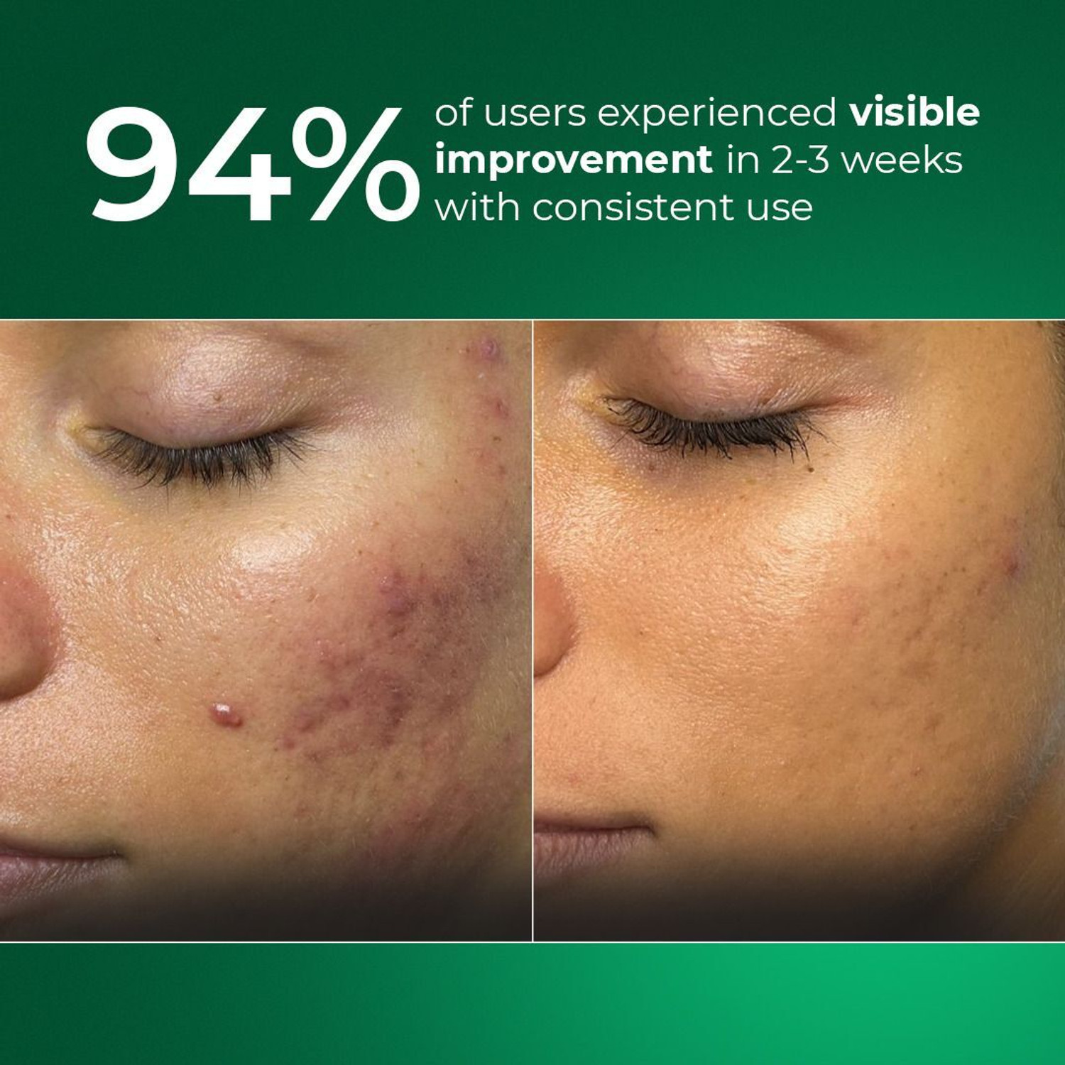 Image of Aqueria 5% Niacinamide Oil Control French Gentle Cleanser Reduces Acne & Marks Acne Prone, Oily Skin Cleanser (Pack of 2) Face Wash