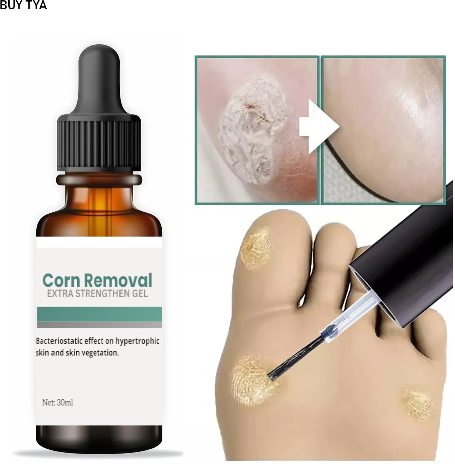 Buy TYA Foot Ease 30ml Corn Remover – Advanced Solution for Corn ...