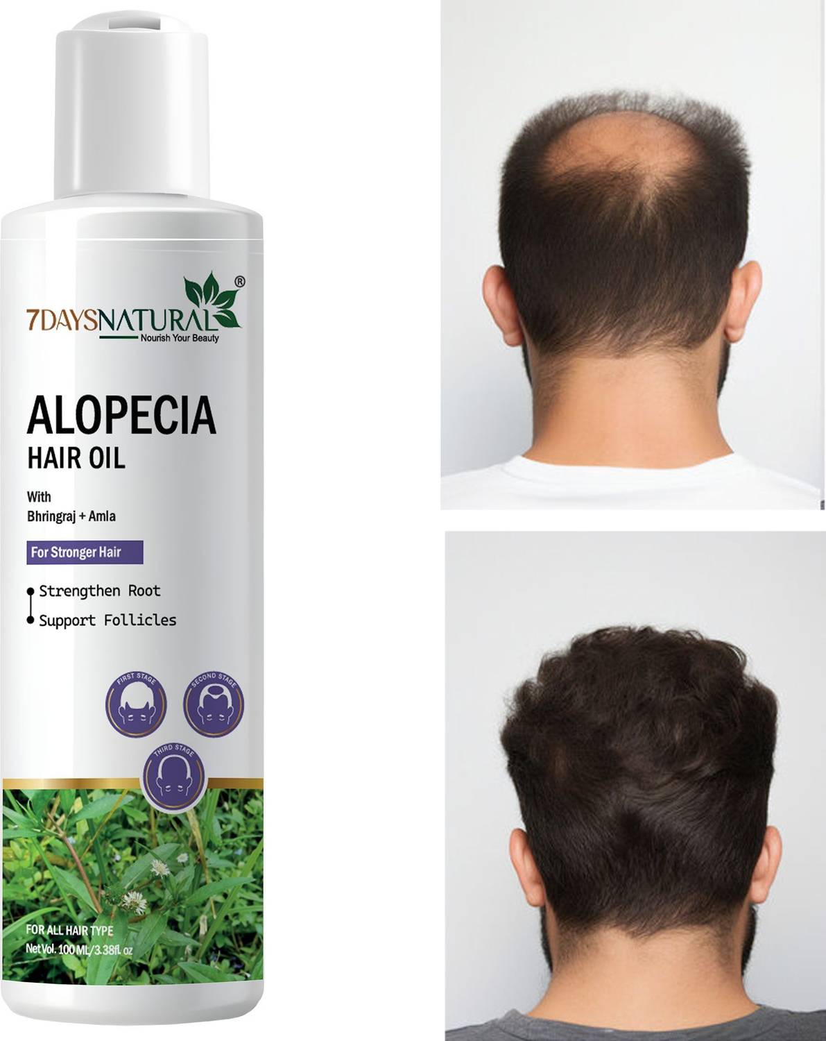 7days natural Alopecia Oil With Neelibhringadi |Bhringaraj Rosemary Amla Reetha Shikakai Hair Oil