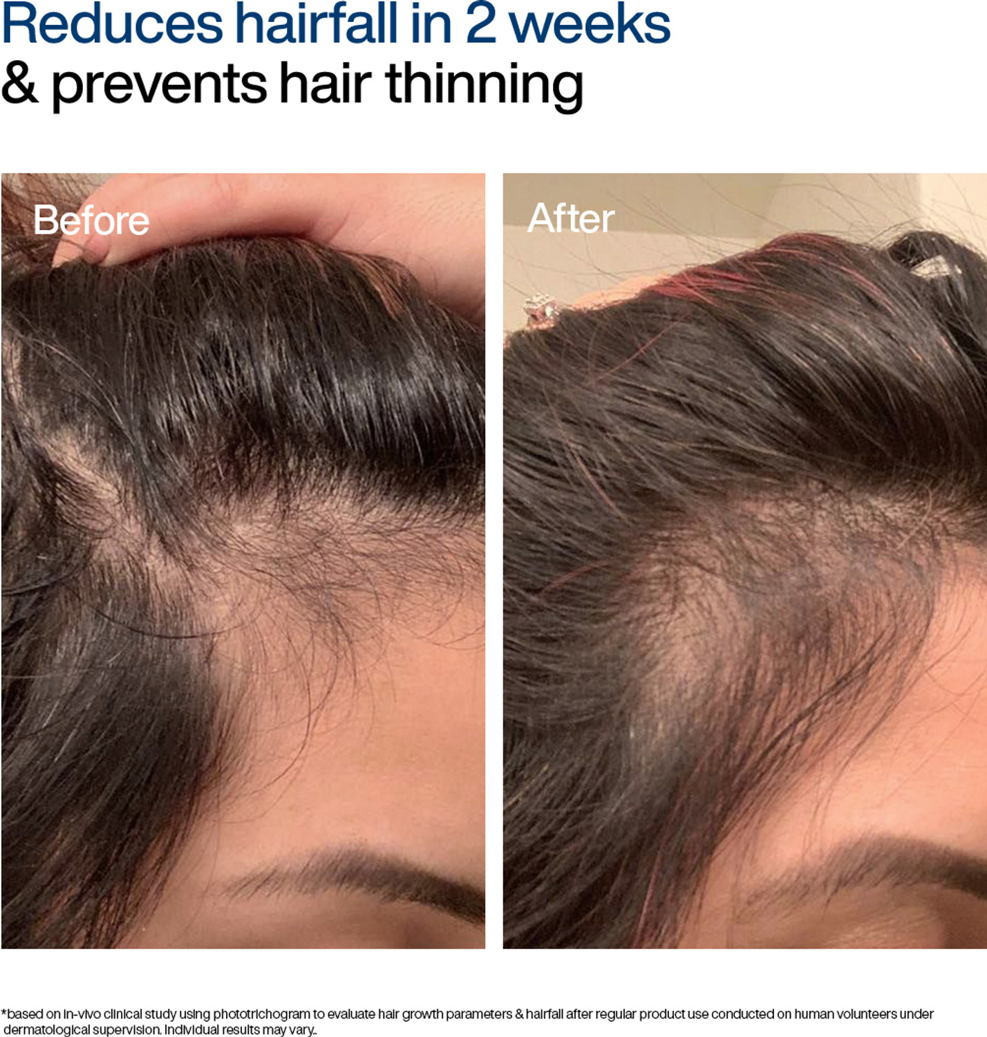 Image of WishCare Hair Growth Serum Roll On With Redensyl | In-Vivo Tested | For Hairfall Control