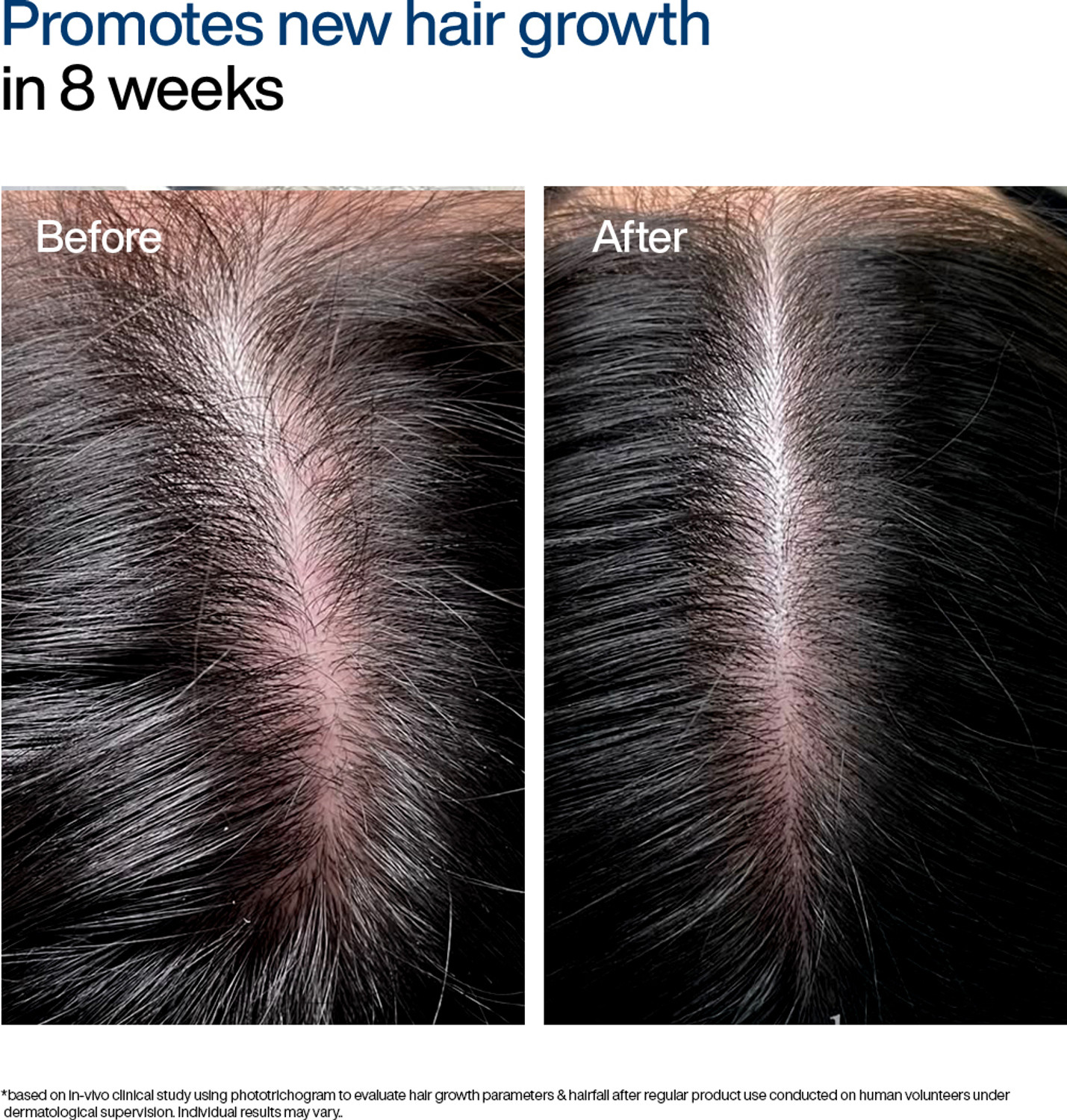 Image of WishCare Hair Growth Serum Roll On With Redensyl | In-Vivo Tested | For Hairfall Control