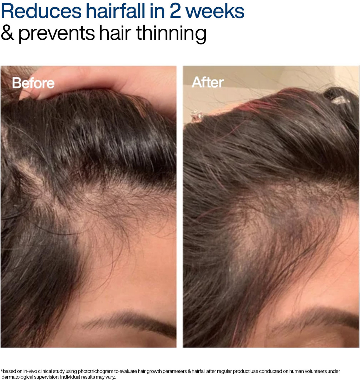 Image of WishCare Foaming Hair Growth Serum | Dermat Tested | Reduces Hairfall |Redensyl & Anagain