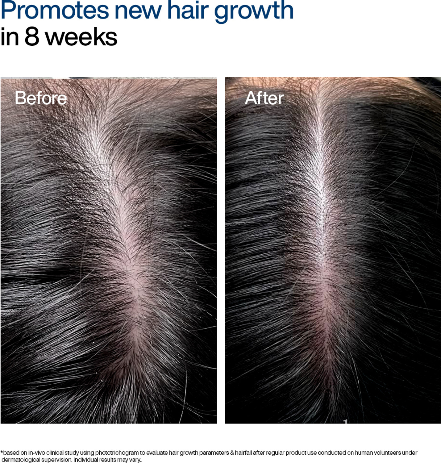 Image of WishCare Hair Growth Serum | In-Vivo Tested | For Hairfall Control | Redensyl & Anagain