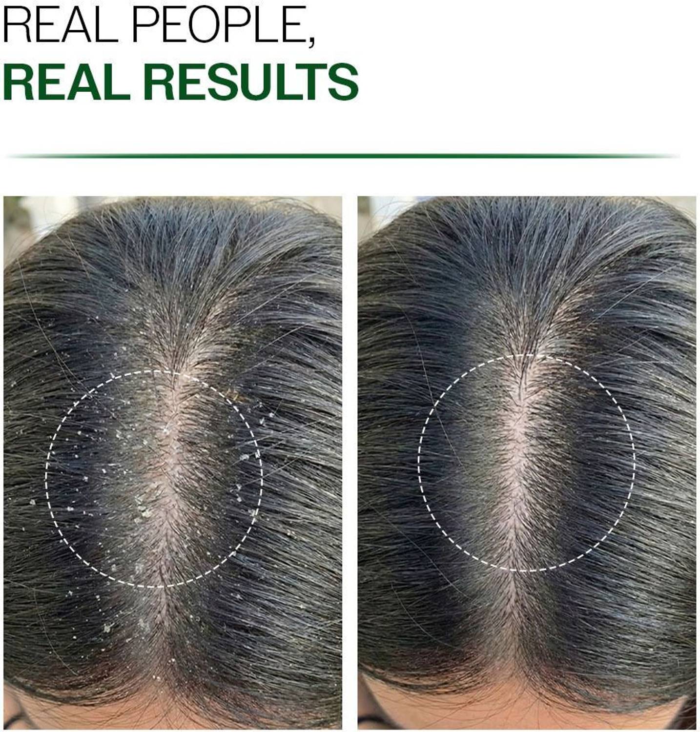 BARE Anatomy Dandruff Control Scalp Spray - Image 5