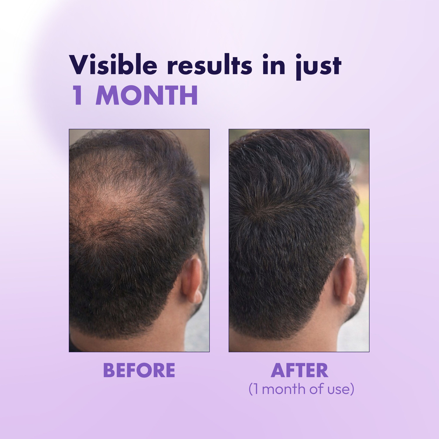 Image of NaturaNari Hair Growth Serum with 3% Redensyl, 4% Anagain, 2% Baicapil For Women & Men (30 ml)