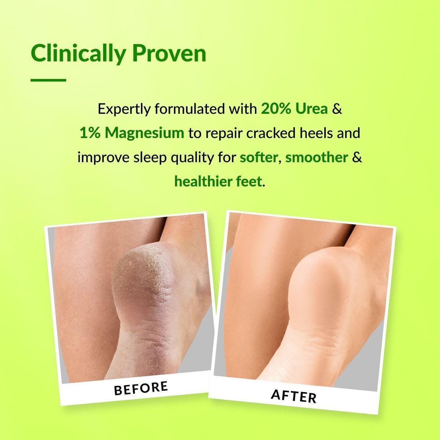 Image of Fixderma Foobetik 20% Urea Foot Roll On For Cracked Heels with 5% Lactic Acid -60ml