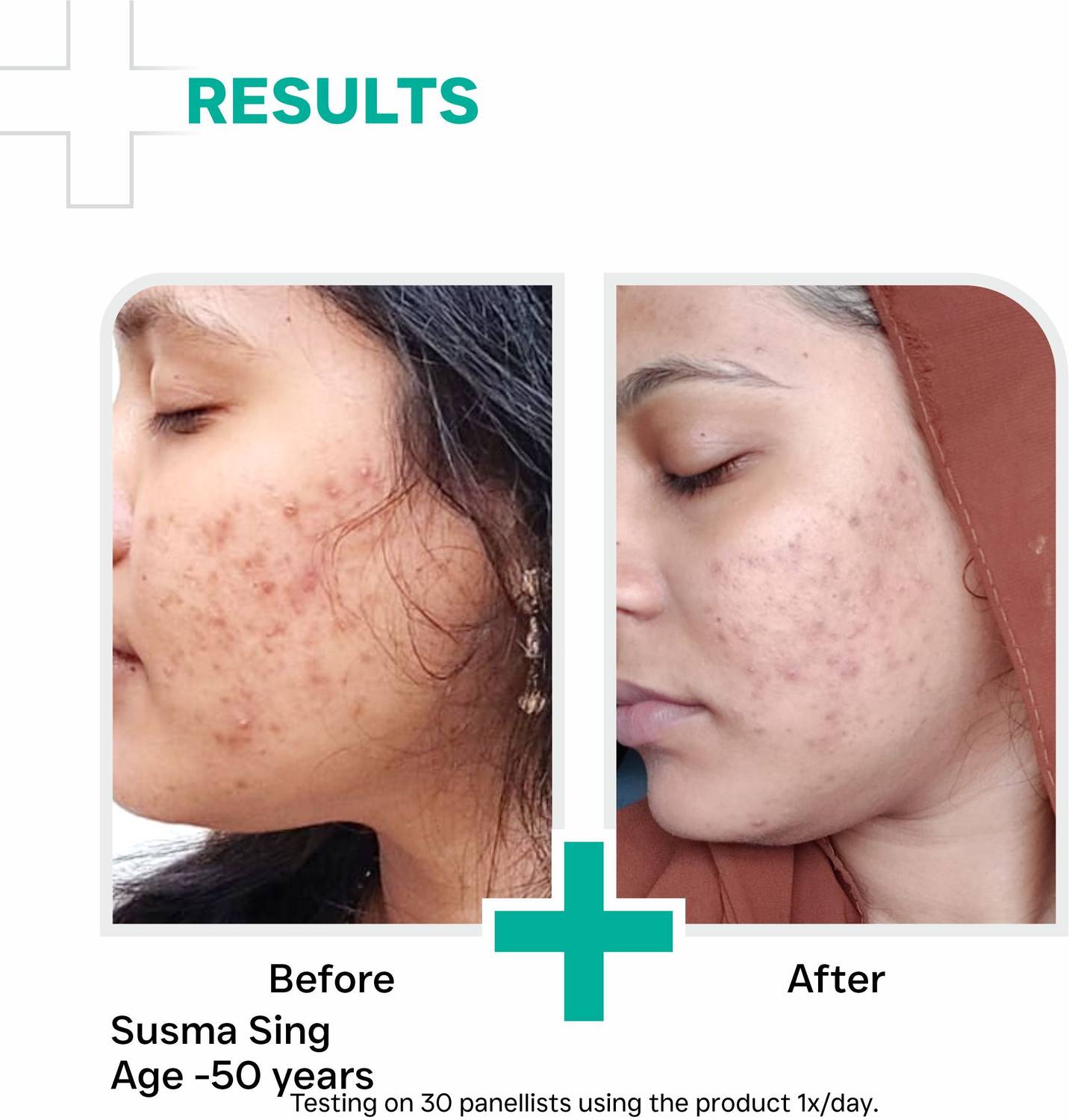 Dermatouch Salicylic Acid 2% Niacinamide 6% Anti-Acne Gel - Image 4