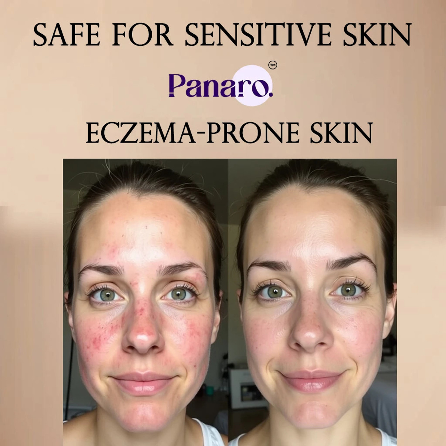 Image of PANARO Eczemar On Anti Fungal Cream For Men & Women