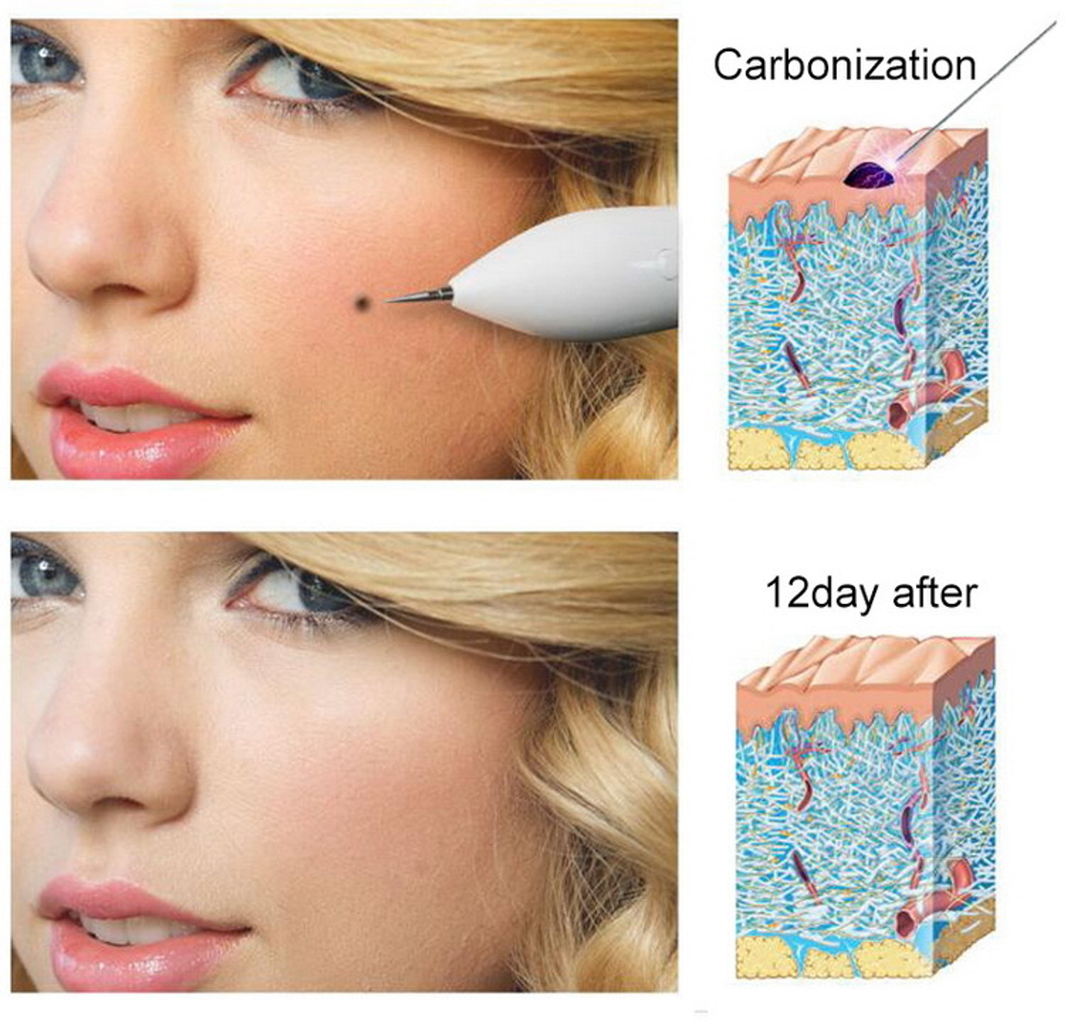 Image of Kostech Electric Freckle Skin Tag Remover Mole Dark Spot Remover Pen Warts Speckle Mucus Removal Device