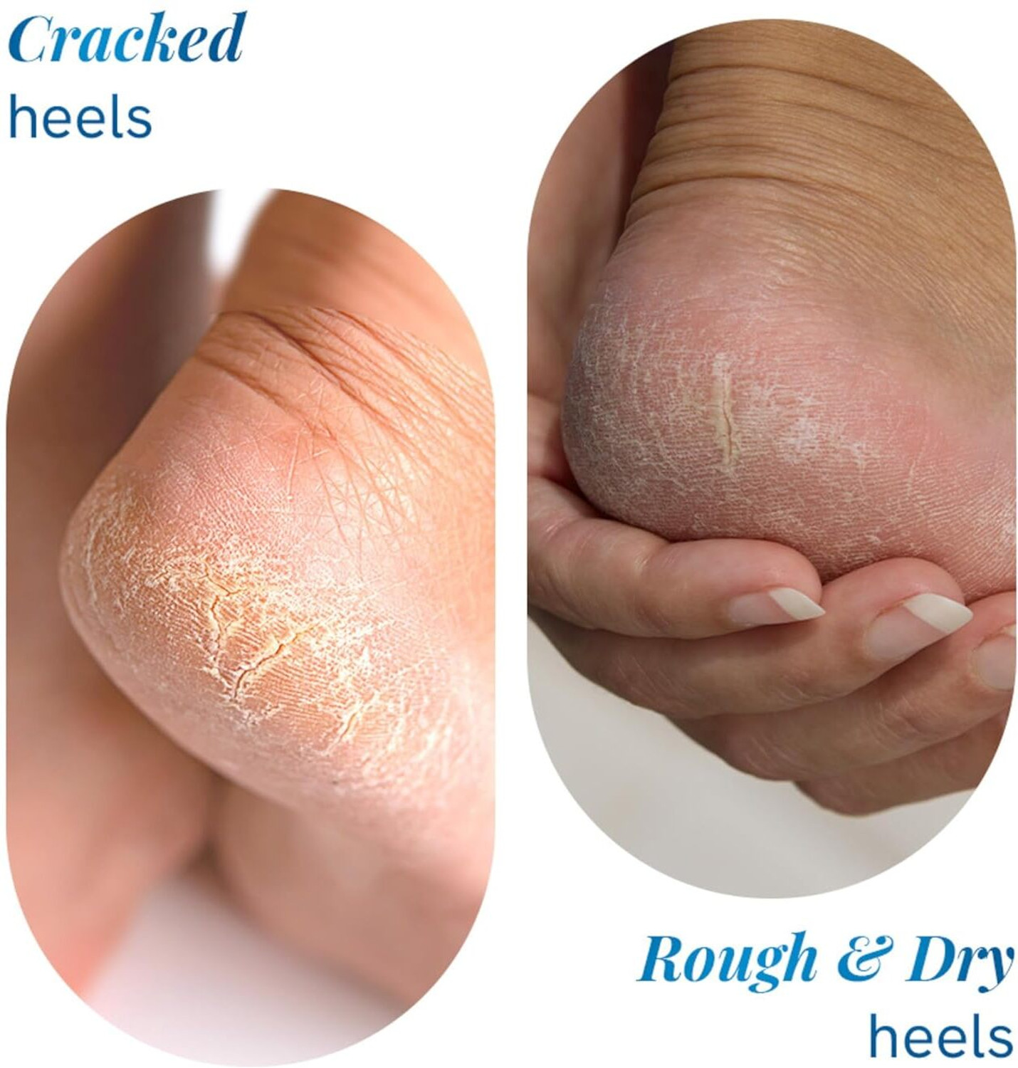 Image of Be Bodywise 30% Urea Foot Roll-On | For Dry & Cracked Heels