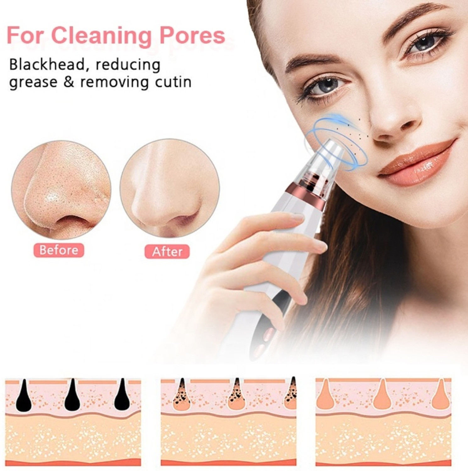 Image of FURESTA Plastic Blackhead Remover Vacuum Suction Device (Pack of 6)