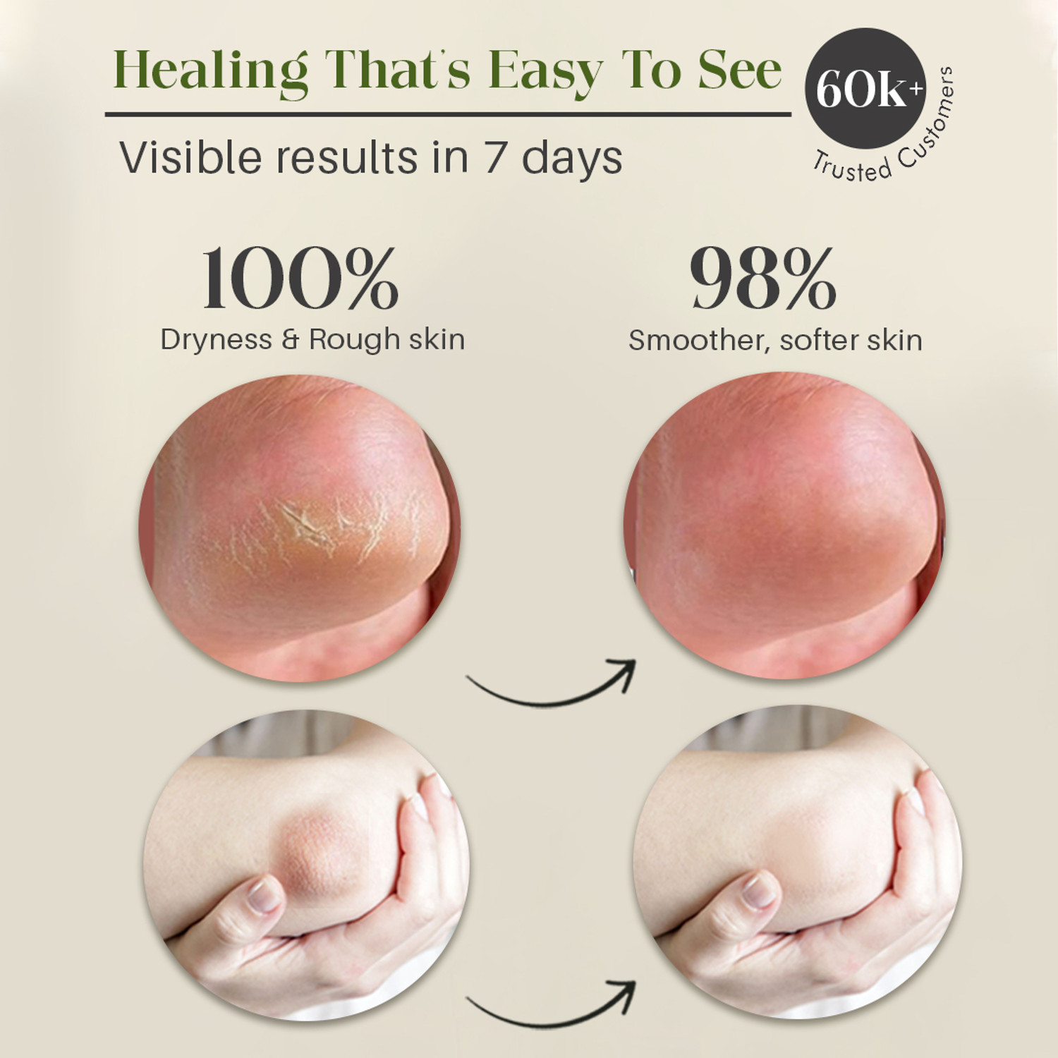 Image of GLAMVEDA Hand & Foot Crack Cream Pack of 3 | Cracked Heel & Dry Skin Repair Cream
