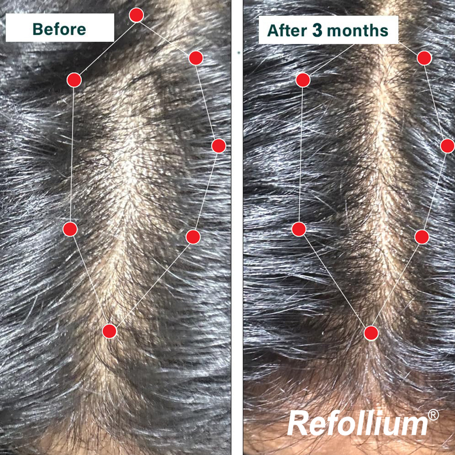 Image of Refollium Hair Vitamins (with Biotin & Iron)for Hair Regrowth & Hairfall Control