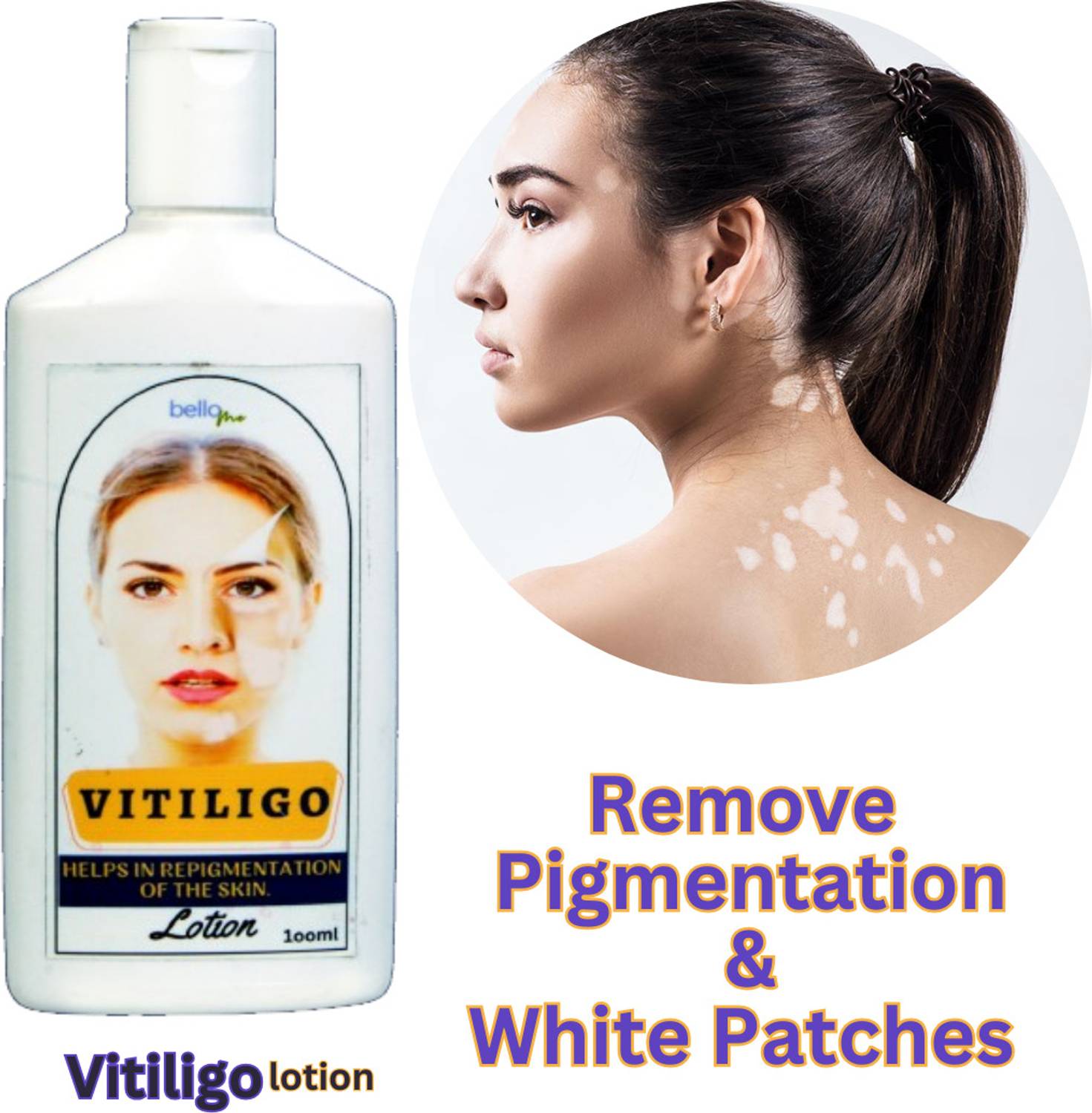glutathione for vitiligo Systematic Review of the Efficacy and Safety of Topical in Dermatology | JCAD A comprehensive reviewon Vitiligo: Pathogenesis,