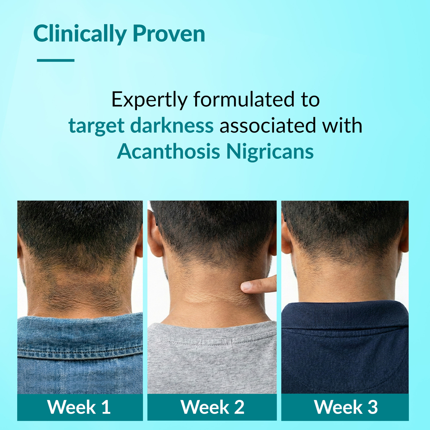 Image of Fixderma Nigrifix Advance Cream For Dark Body Parts Neck, Ankles, Armpits, Thighs, Elbows