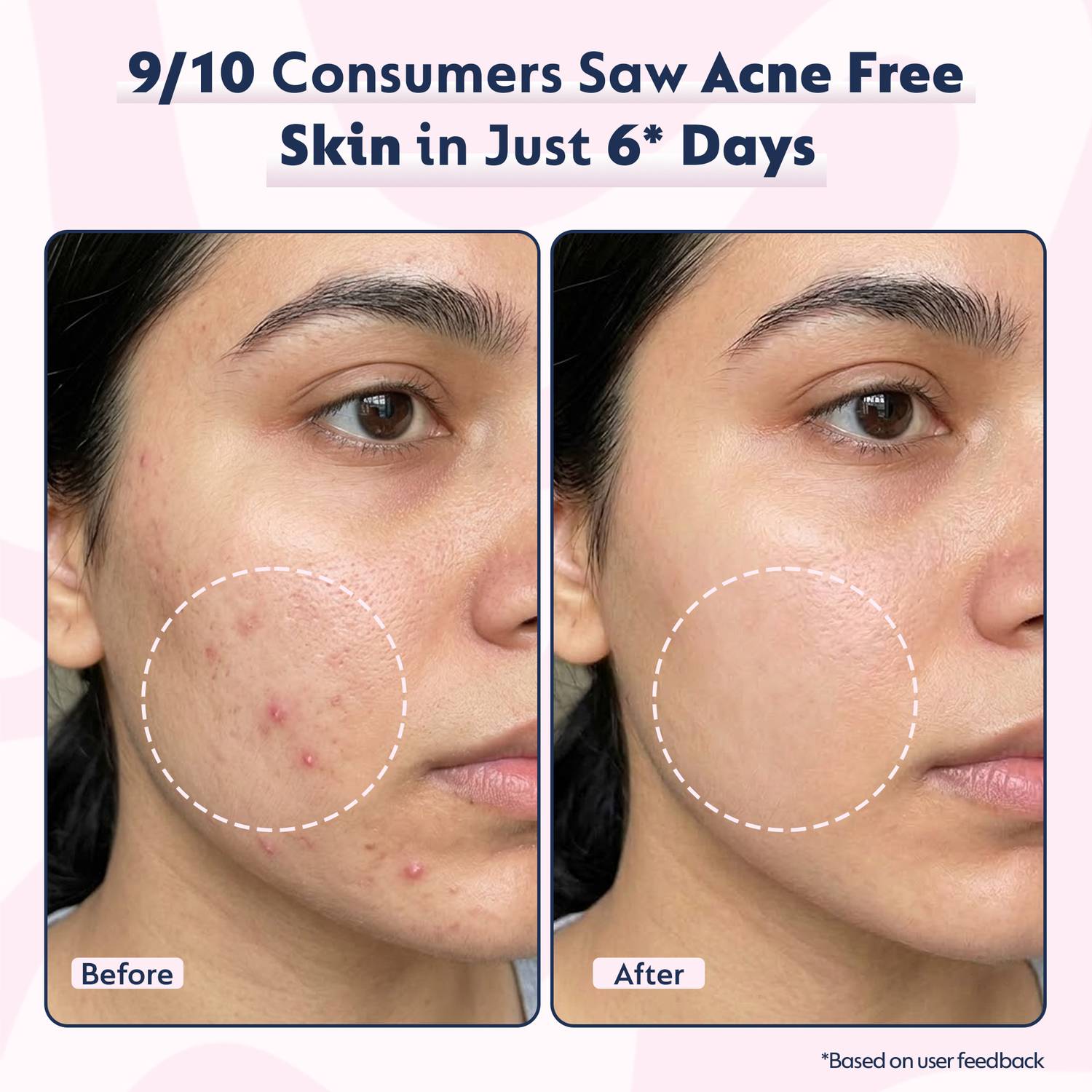Humuss Beauty Super Glow Acne Control Face Wash - Image 5