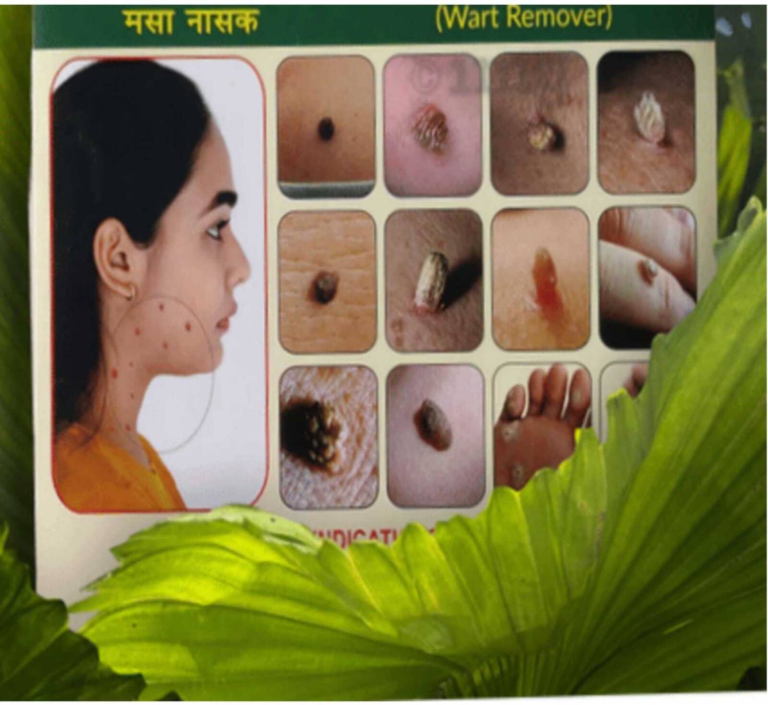 Wartosin Ayurvedic Wart Remover - 3g - Image 2