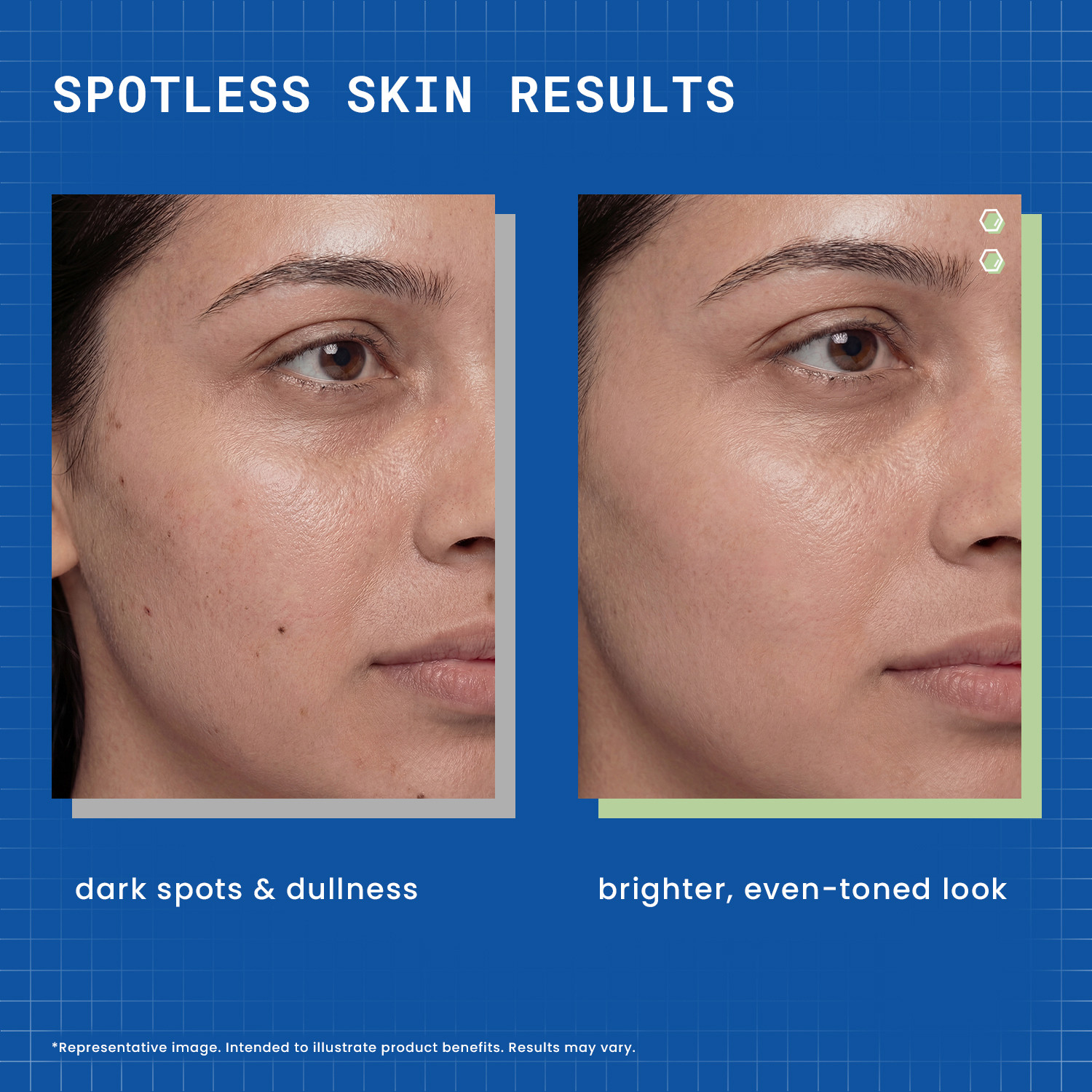 Image of DermDoc Kojic Acid Face Serum | Reduces Acne Marks, Dark Spots & Pigmentation | Brightens Skin