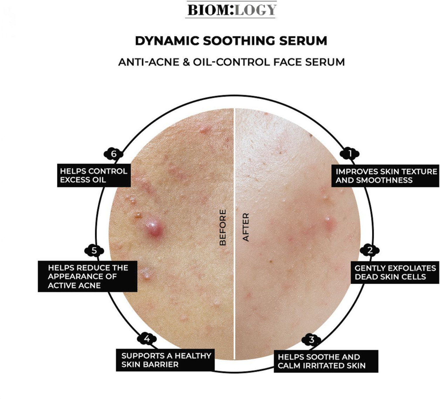 Image of Biomlogy Anti Acne Serum 2% Salicylic Acid 7% Niacinamide, Ceramide Controls Excess Oil