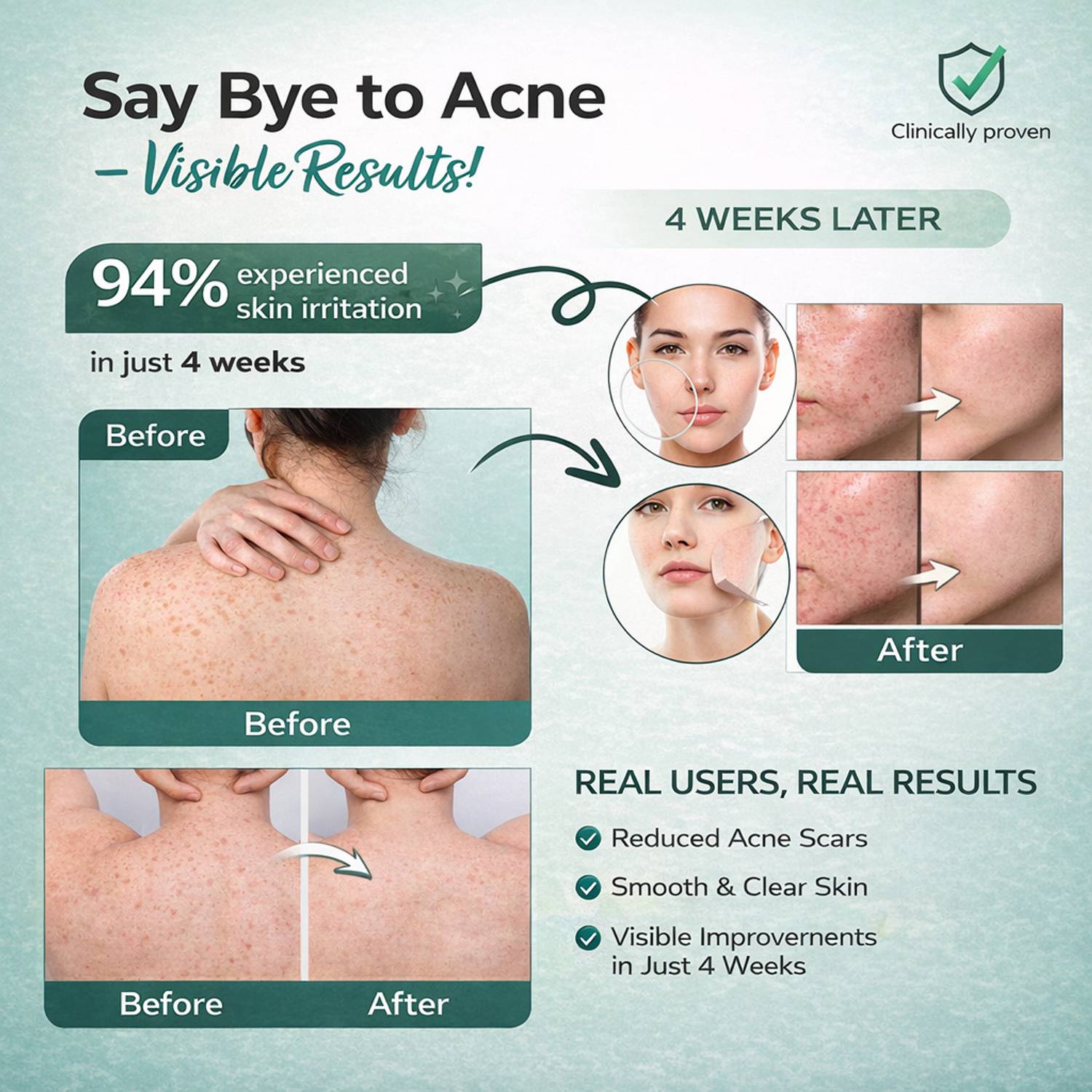 Skinlure Anti Acne Spray 2% Salicylic Acid - Image 3