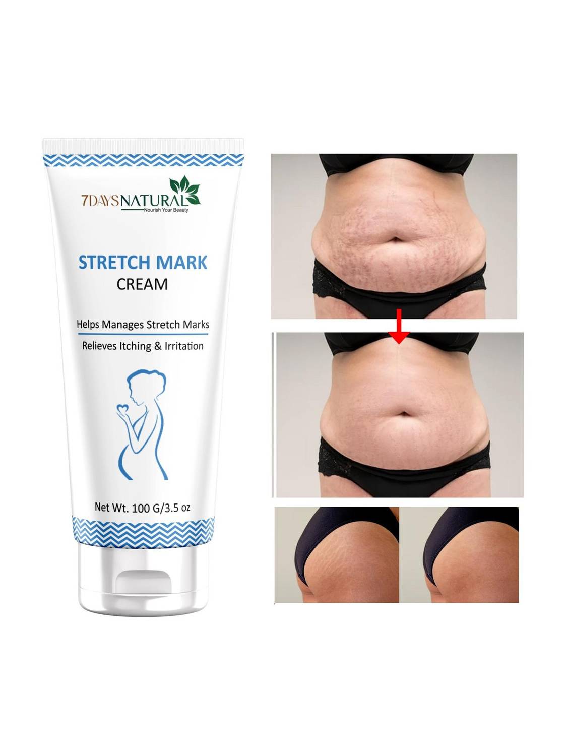 7days natural Say Goodbye to Stretch Marks with our Stretch Marks Cream Reduce� Scars