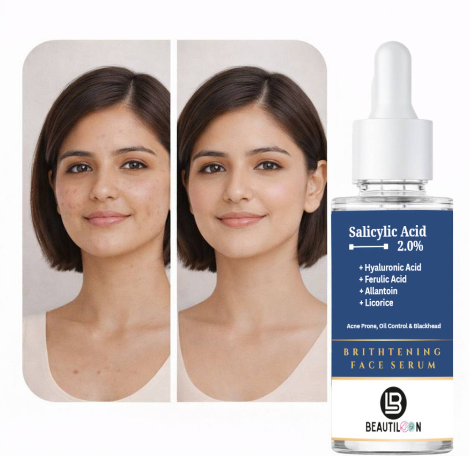 beautiloon Salicylic Acid Serum with Hyaluronic & Ferulic Acid for Brightening, Pigmentation Removal, Redness Soothing & Anti-Aging Skin Renewal (30 ml)