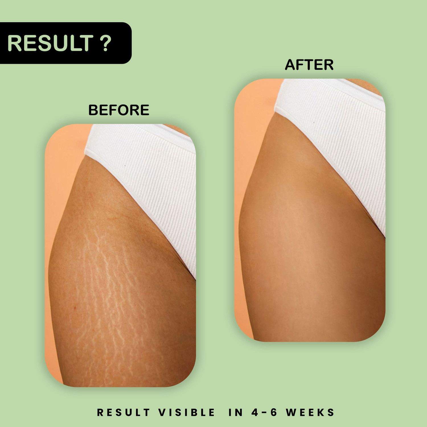 Image of Ayumcure Stretch Mark Removal & Prevention Oil for women | Improves Skin Texture & Tone