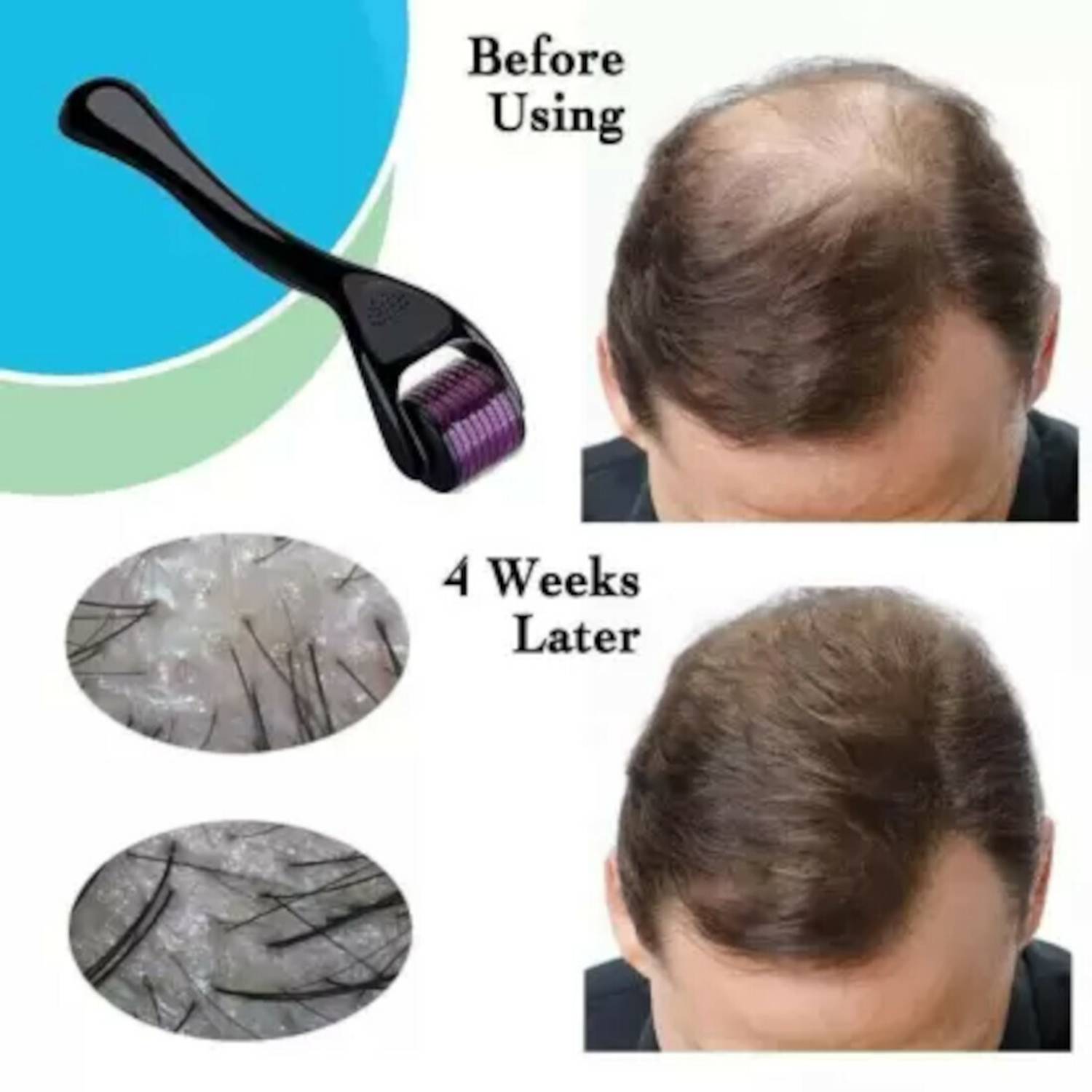 AcuHealth Derma Roller 0.5 mm For Hair Regrowth, Face Acne Scars & Skin Ageing