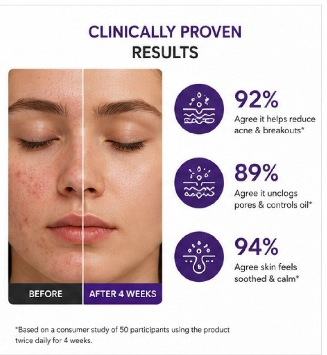 Image of keydiyam 2% Salicylic Acid Face Serum for Active Acne Control for Oily Acne Skin