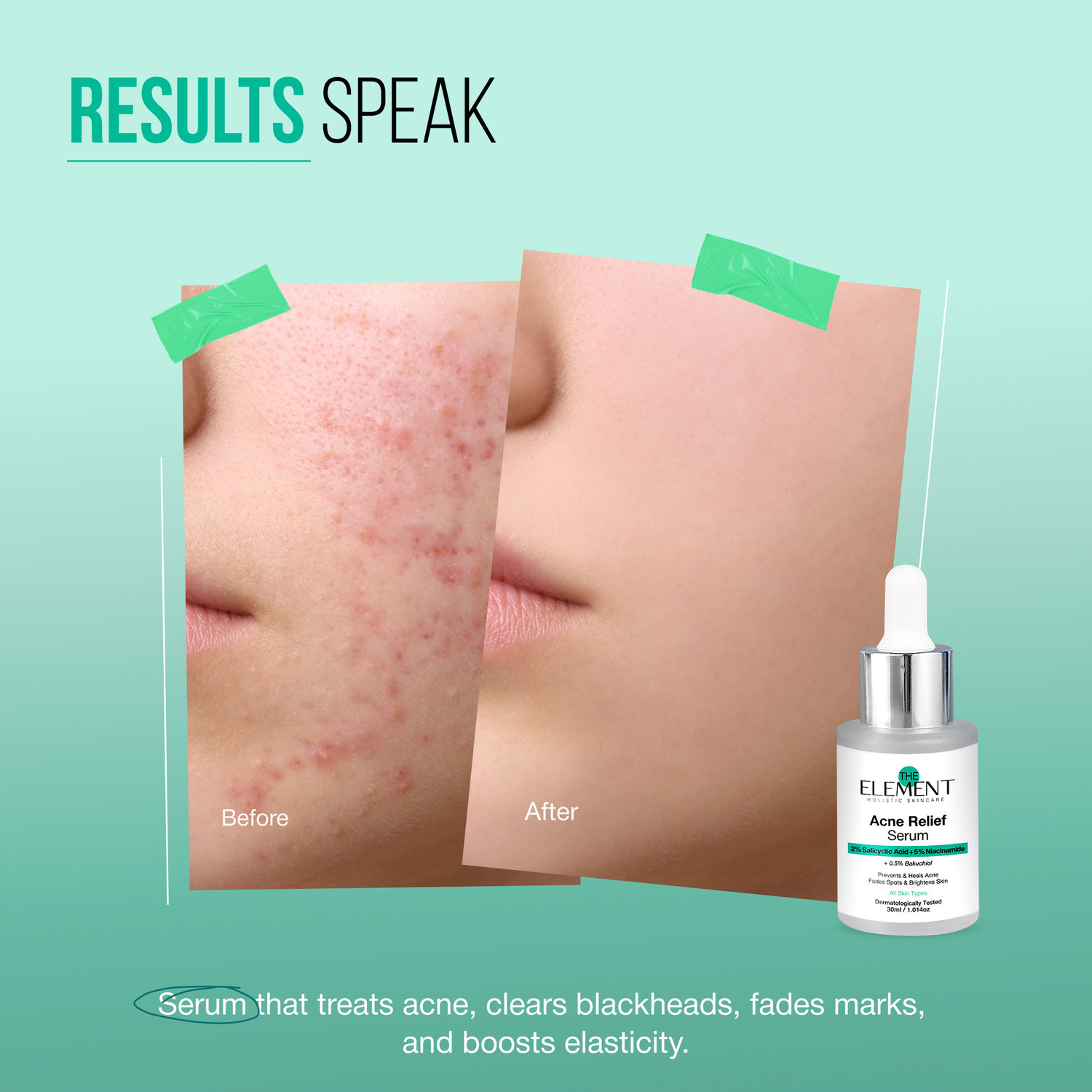 Image of the element 2% Salicylic Acid Serum with 5% Niacinamide & 0.5% Bakuchiol | Acne Relief, Oil Control, Pore Minimizing, Anti Acne Face Serum for Oily Skin, Pimples & Acne Scars