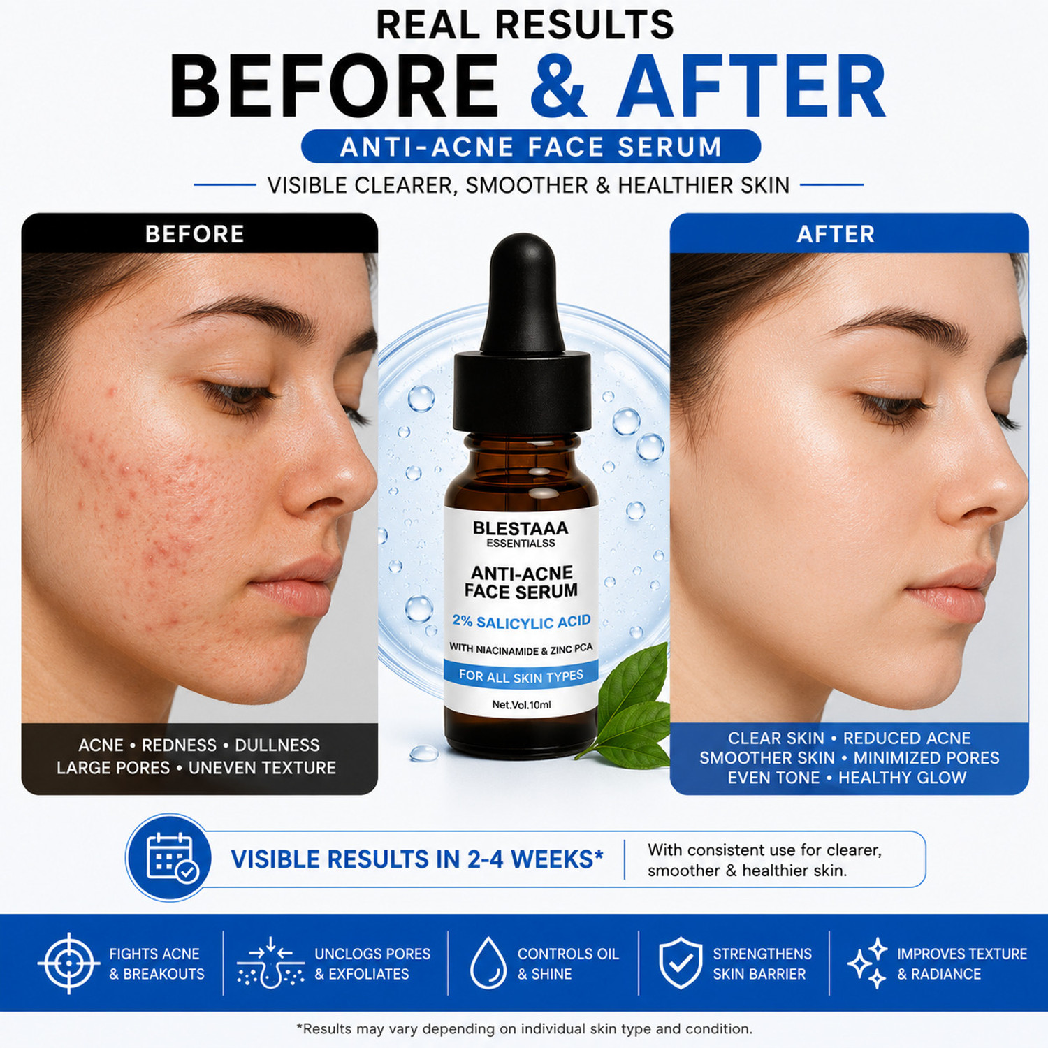 Image of blestaaa essentialss 2% Salicylic Acid AcneClear Face Serum with Niacinamide & Zinc PCA | Oil Control, Pore Cleansing & Acne Reduction | For Oily & Acne-Prone Skin