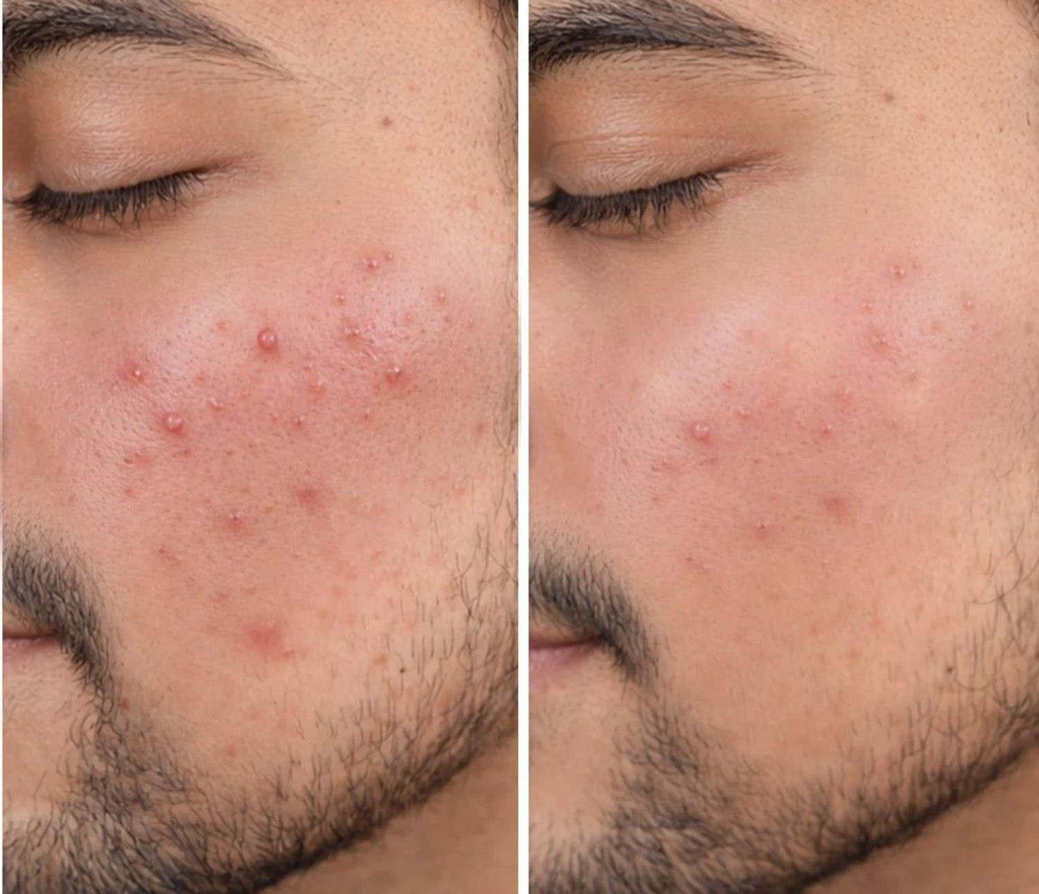 Image of Biomlogy Anti Acne Serum 2% Salicylic Acid 7% Niacinamide, Ceramide Controls Excess Oil